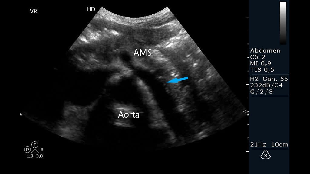 Aorta Ultrasound Sma