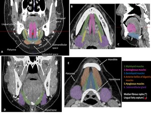 Ecr 2019 C 2845 Mdct Of The Floor Of The Mouth A Pictorial