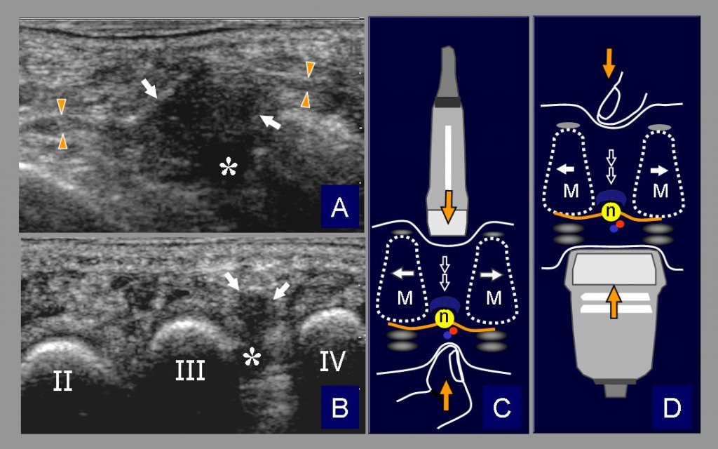 foot neuroma ultrasound