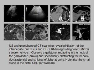 Ultrasound images • Intrahepatic calcification, B-mode, echogramm №23