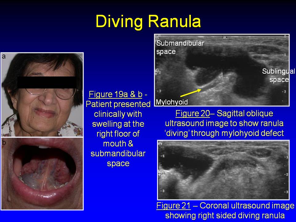 ranula ultrasound