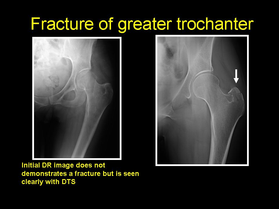 greater trochanter fracture