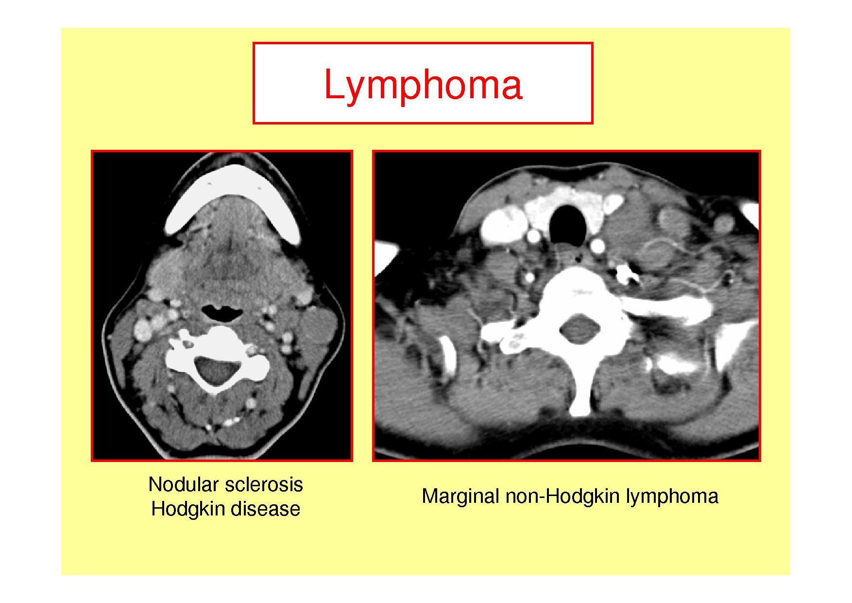 hodgkins lymphoma radiology