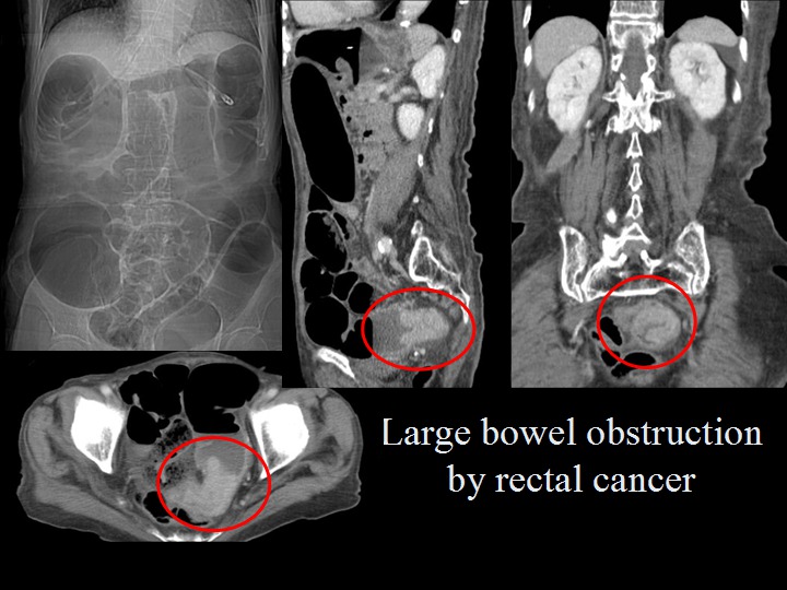 rectal cancer obstruction