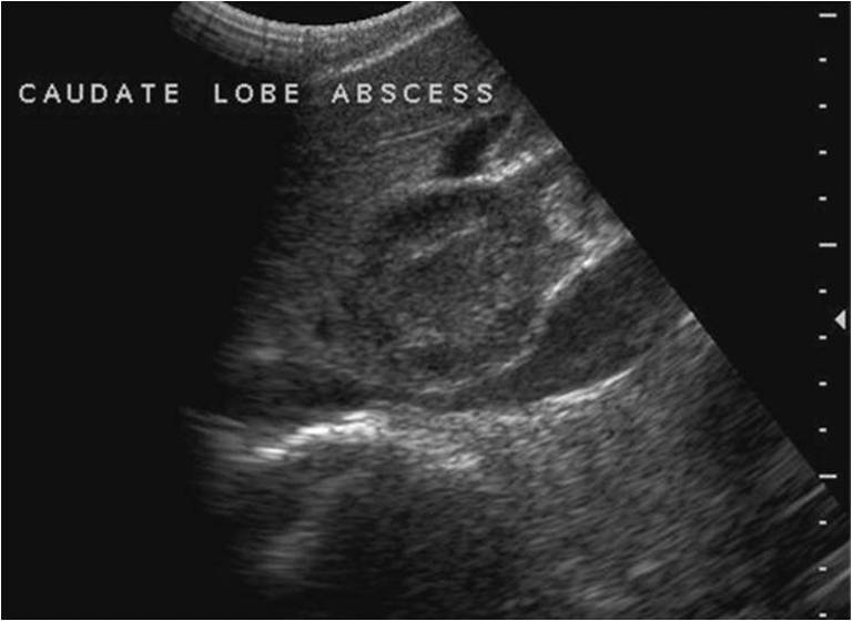 caudate lobe of liver ultrasound