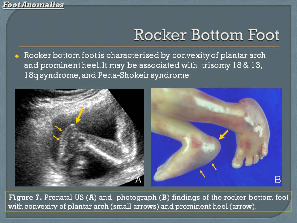 rocker bottom feet ultrasound