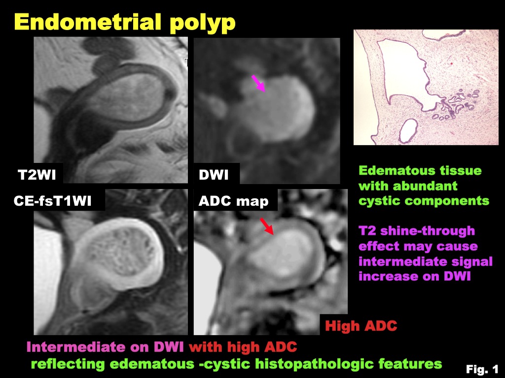 Cancer endometrial polyp -