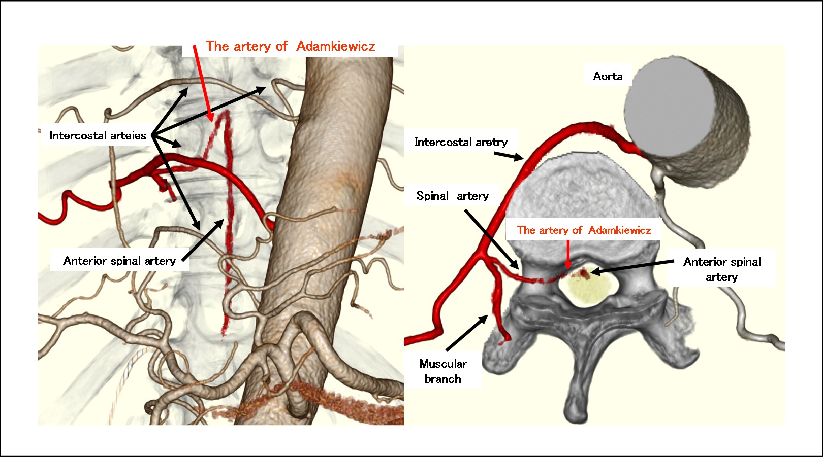 artery of adamkiewicz diagram