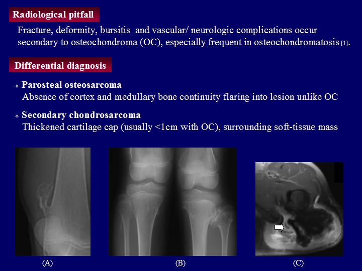 osteocondroza articulațiilor