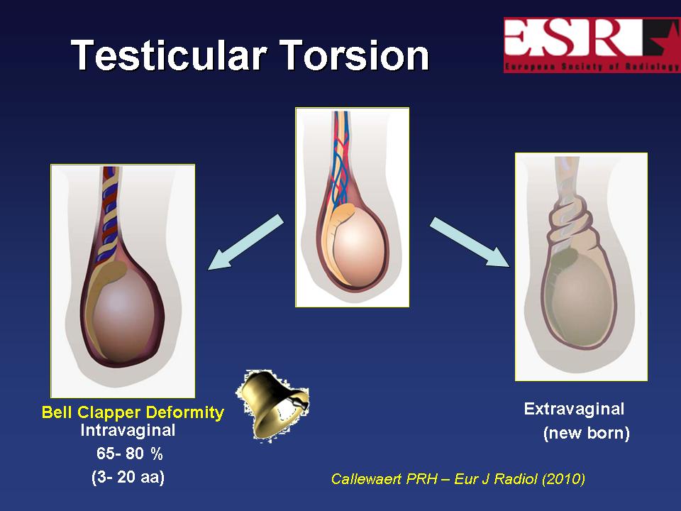 testicular torsion intravaginal