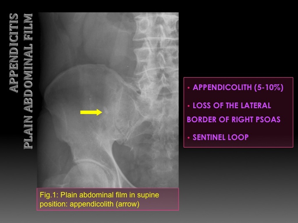 sentinel loop appendicitis