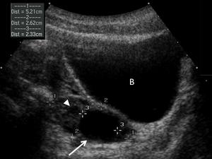 graafian follicle ultrasound