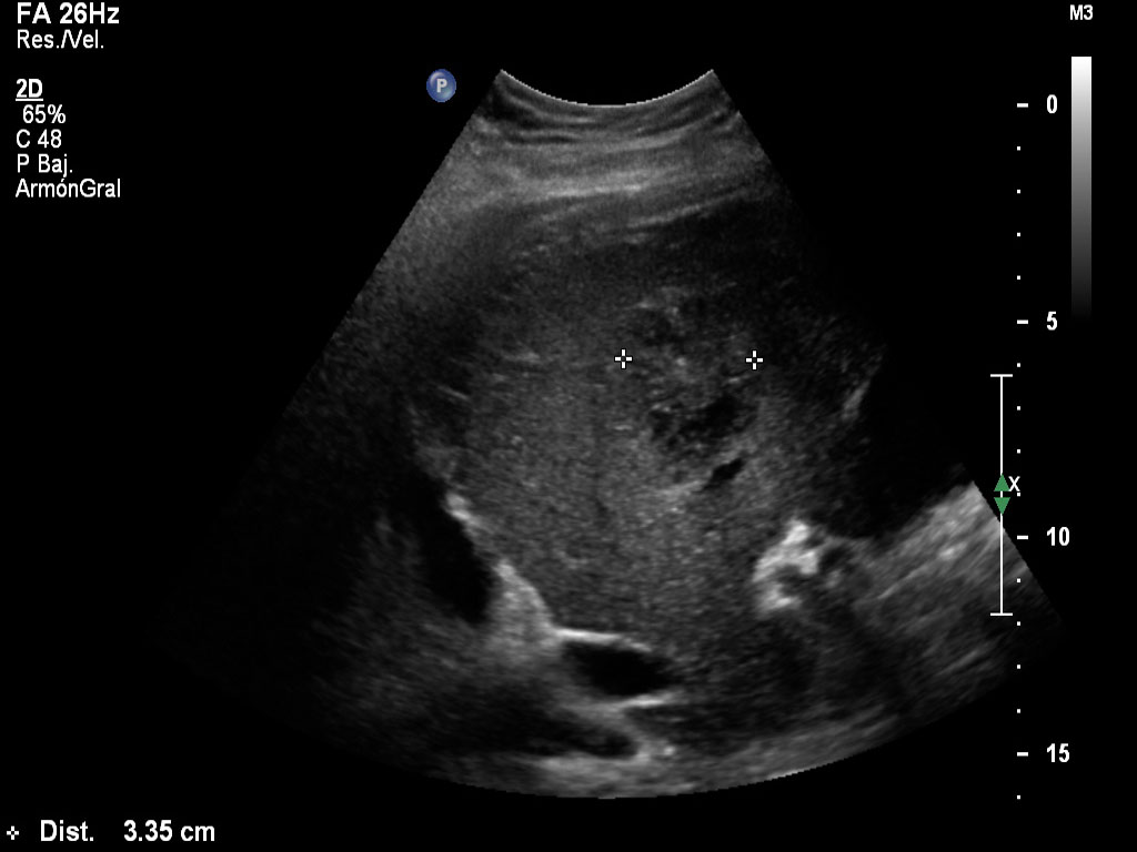 Ultrasound images • Liver, B-mode, echogramm №847