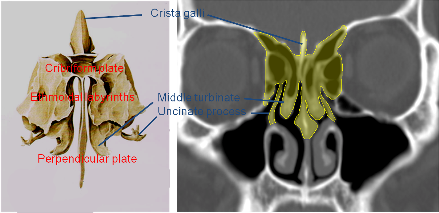 Perpendicular Plate Of Ethmoid Bone Ct - slidesharetrick