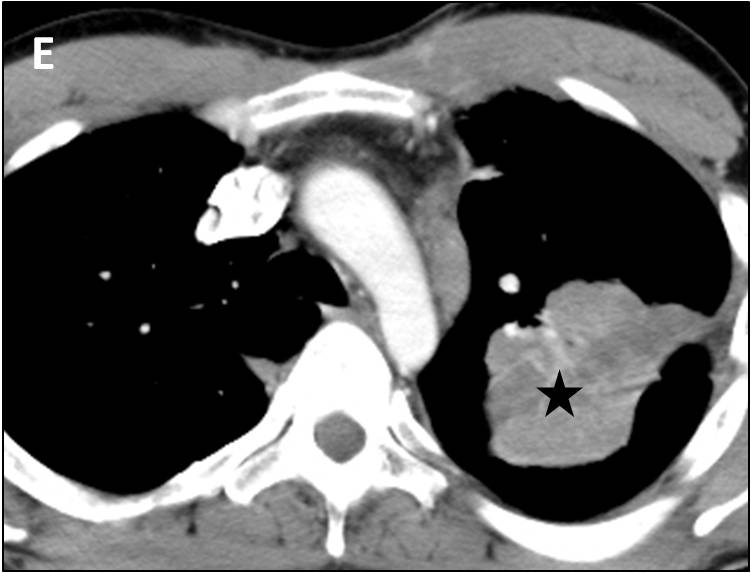 papillomatosis with lung involvement