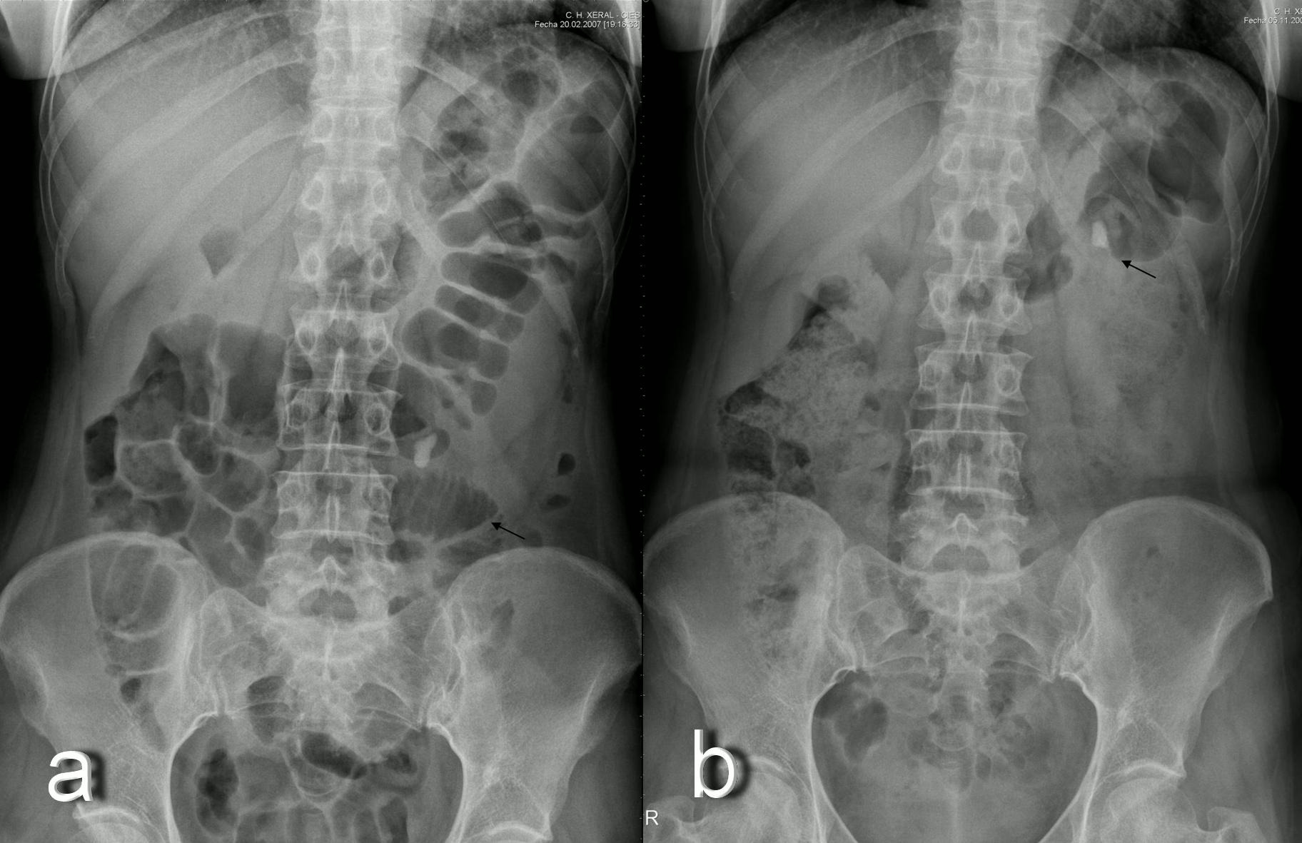 pyelonephritis x ray