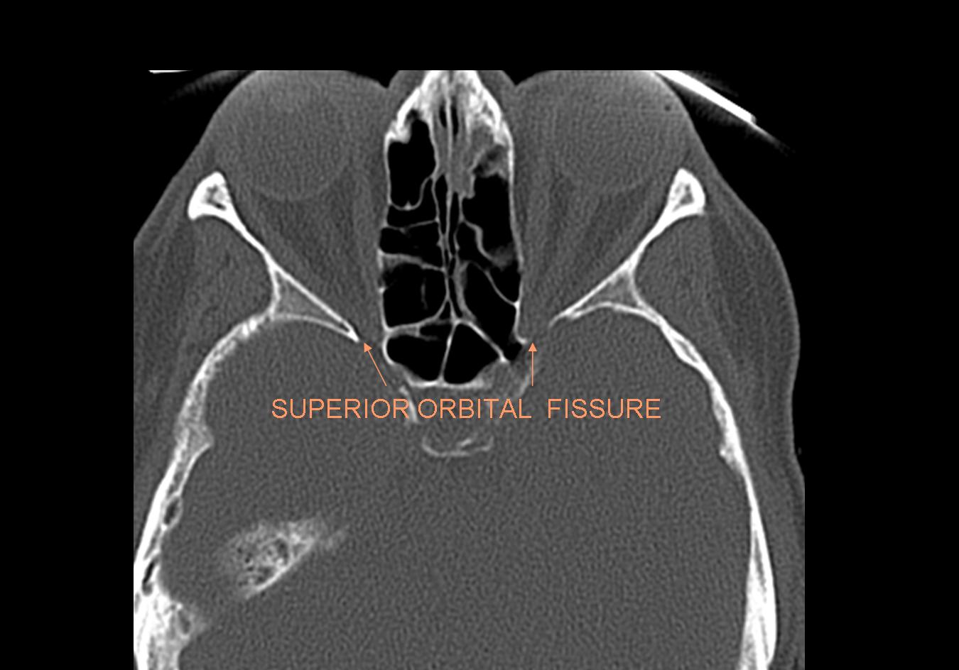 superior orbital fissure radiology