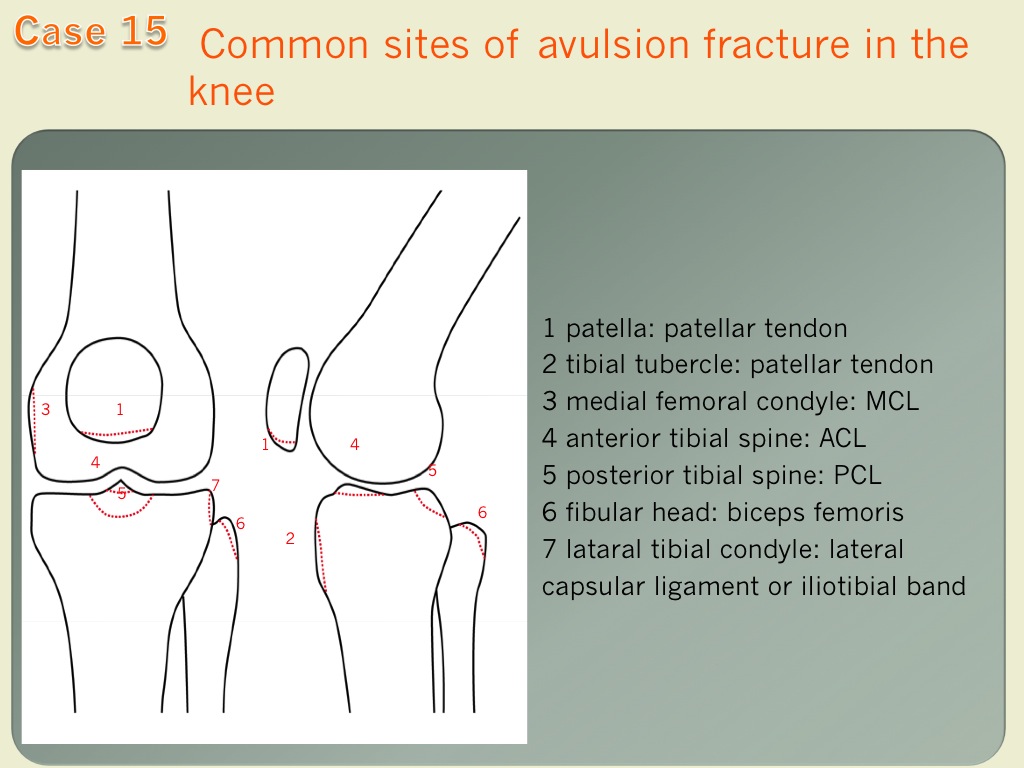 avulsion fracture knee