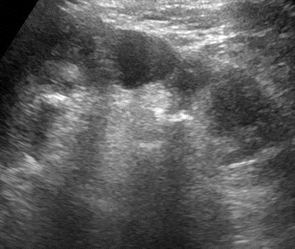 xanthogranulomatous pyelonephritis ultrasound