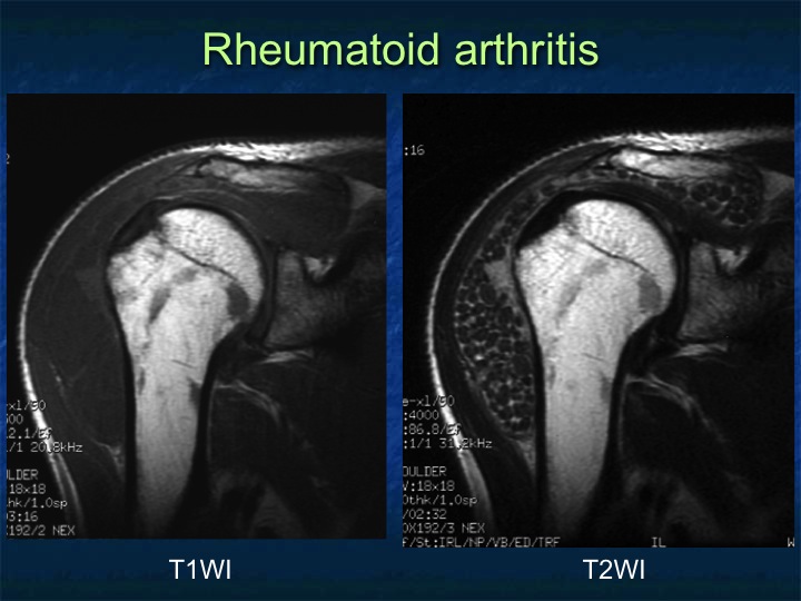 rheumatoid arthritis shoulder