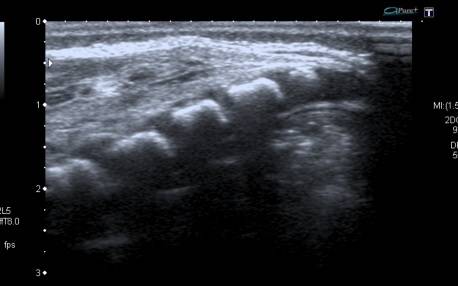 sacral dimple ultrasound