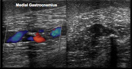 gastrocnemius vein ultrasound
