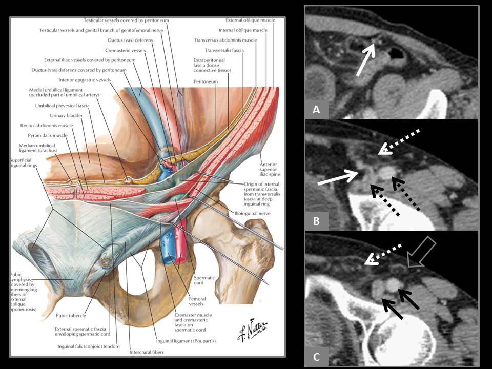 Indirect Inguinal Hernia. By definition, the hernia enters the inguinal...  | Download Scientific Diagram