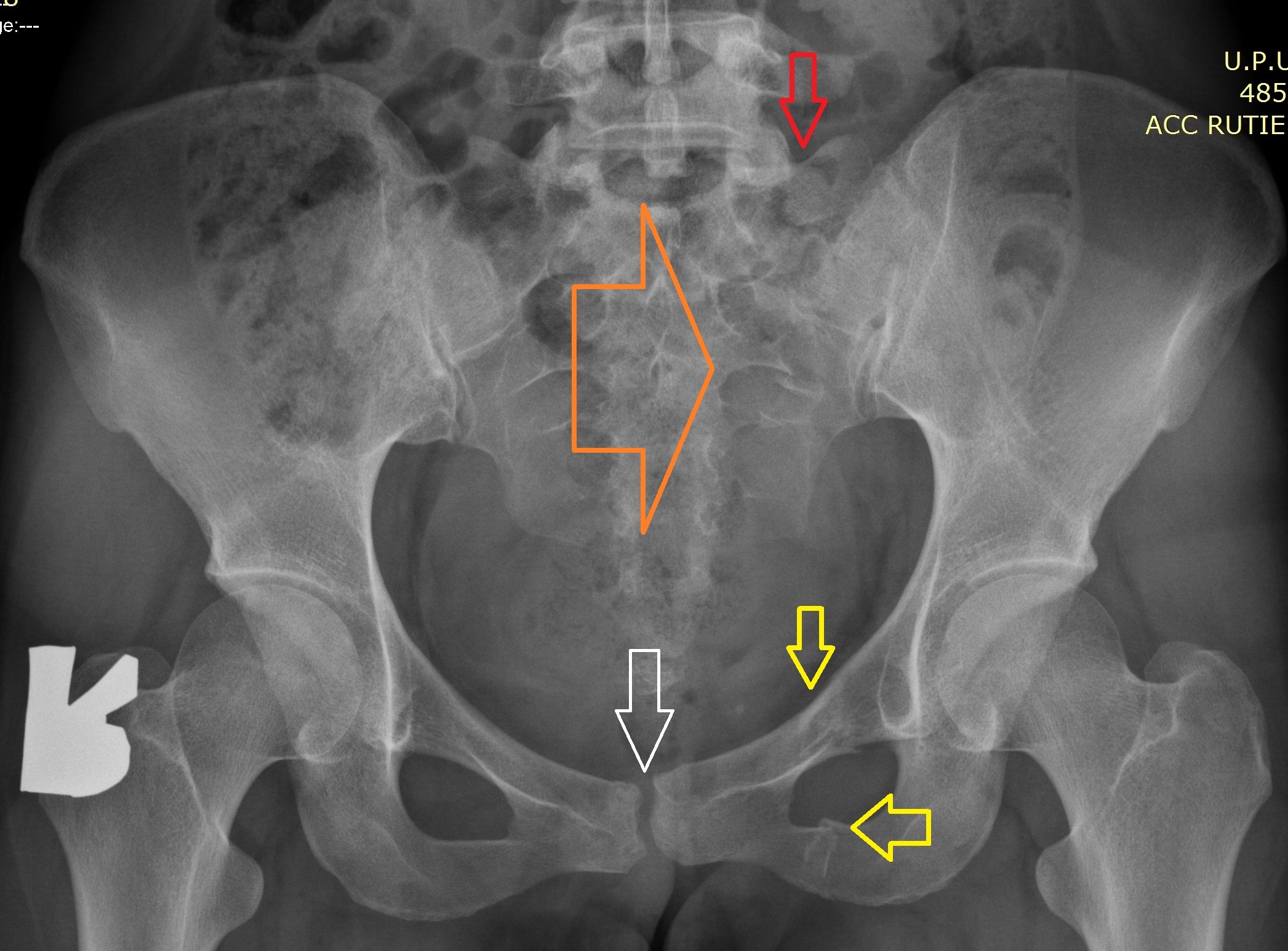 transverse process fracture x ray