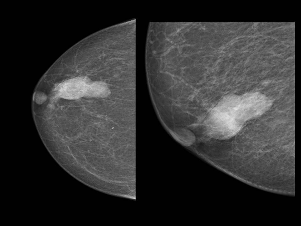 intraductalis papilloma mammogram