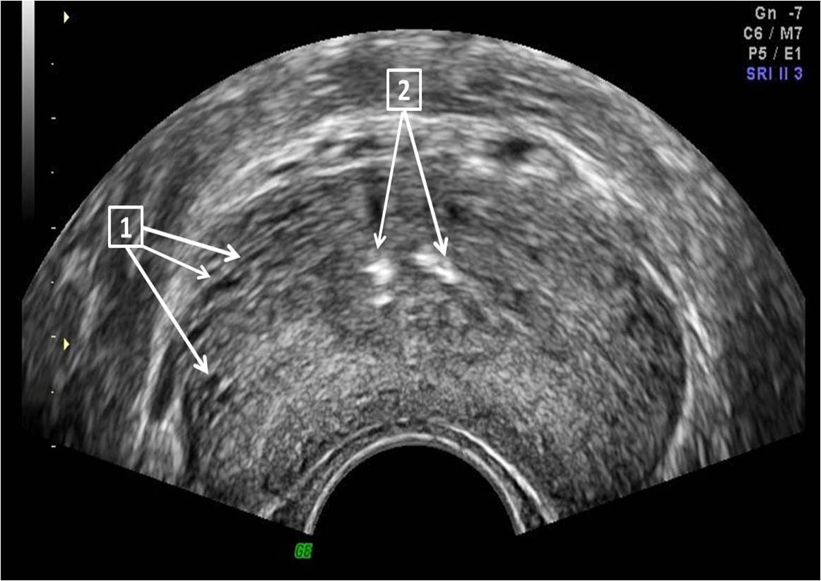 prostate calcification ultrasound images prostatita curativa