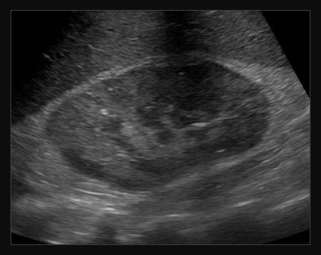 xanthogranulomatous pyelonephritis ultrasound