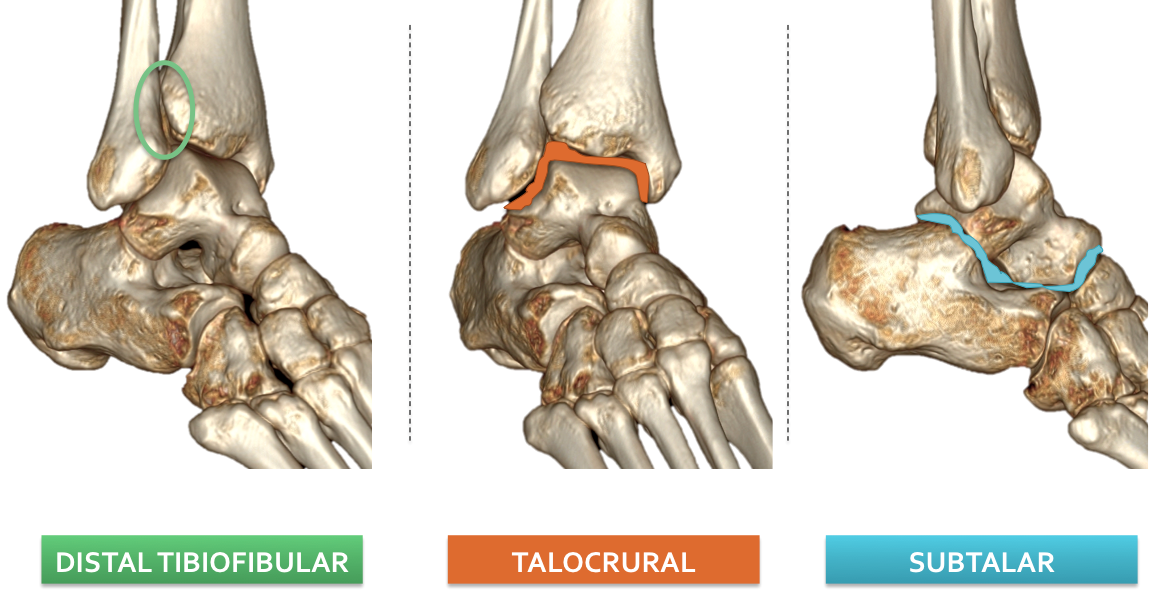 Ankle Joint Anatomy: Talocrural, Subtalar and Tibiofibular Joints