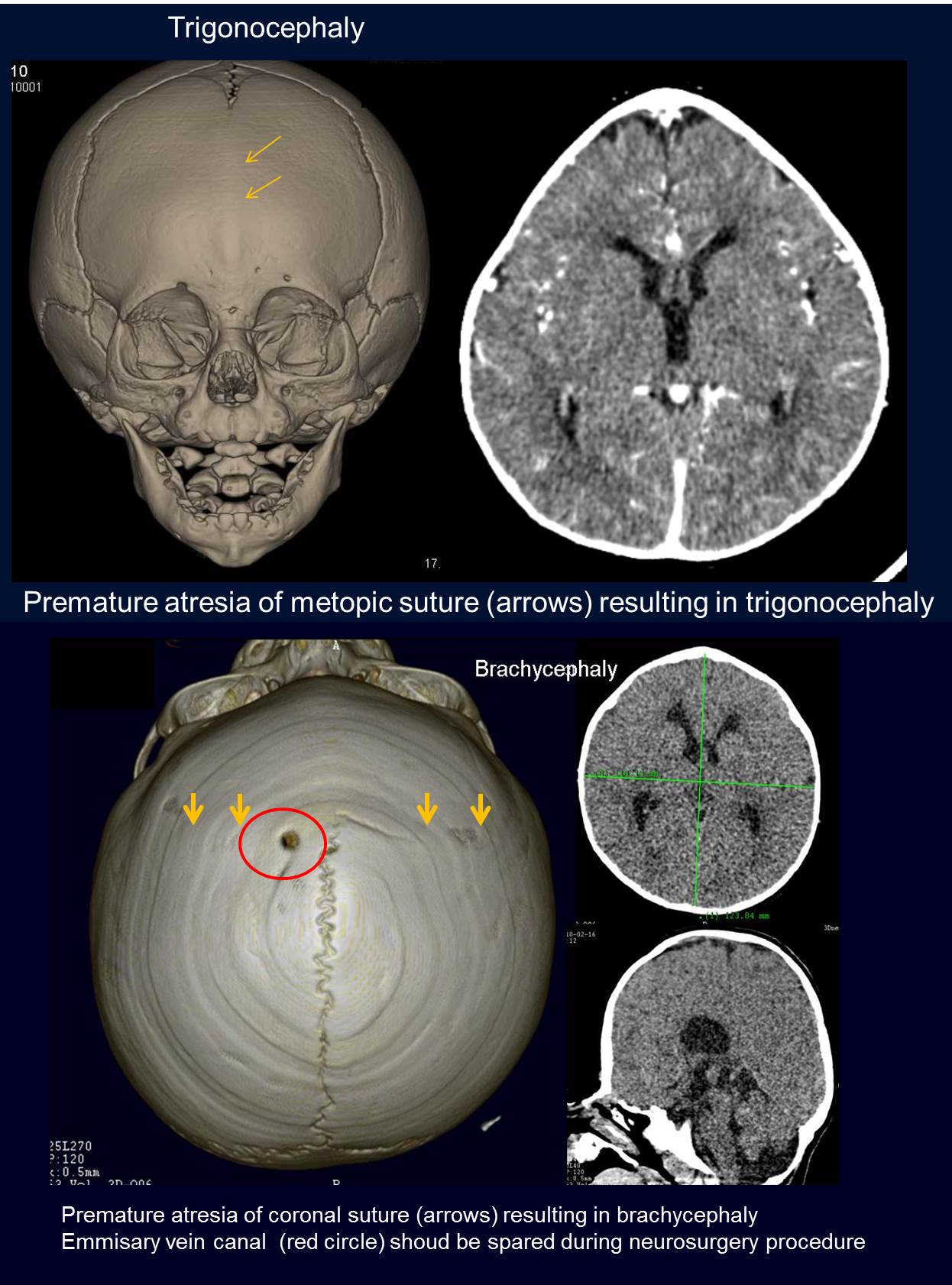 trigonocephaly ct scan