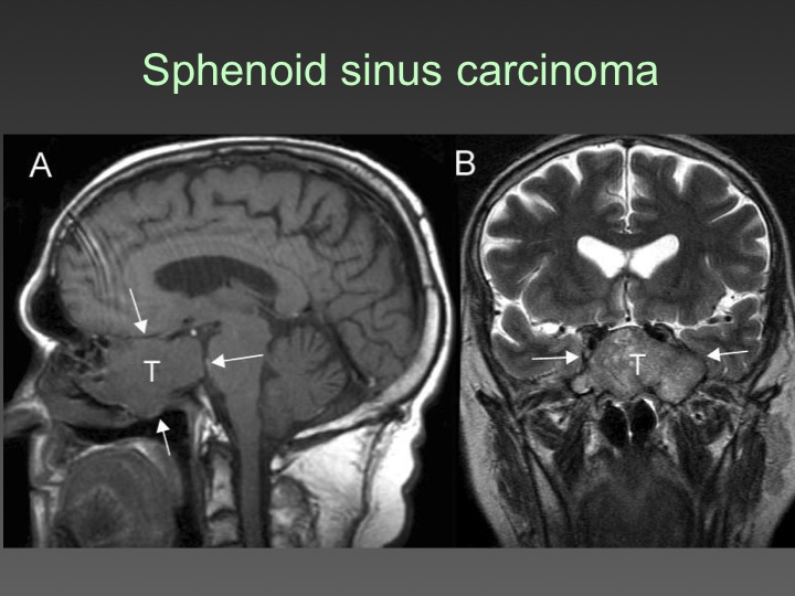 sphenoid sinus tumours