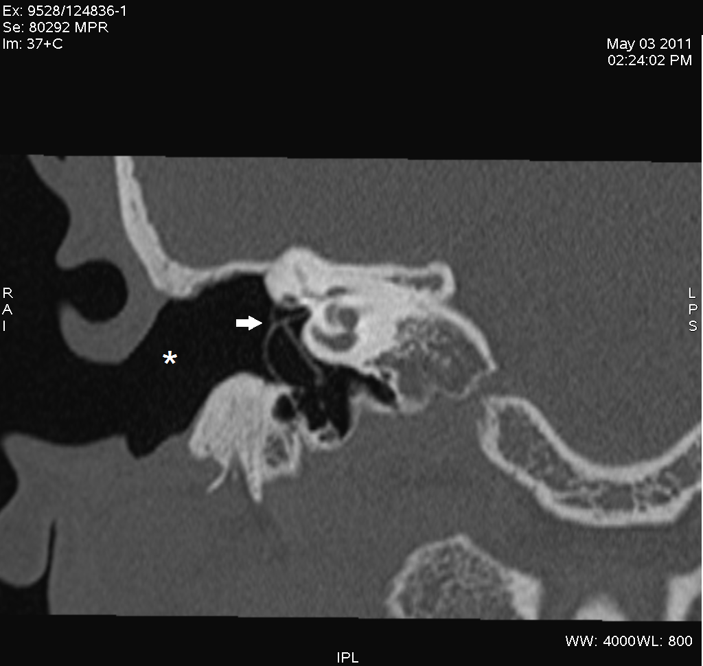 canal wall down mastoidectomy radiology