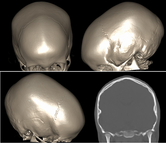 skull fracture calcification