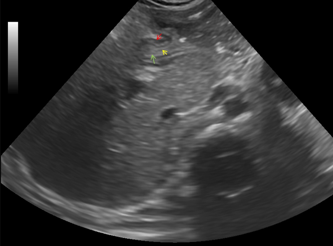 pyloric stenosis ultrasound protocol
