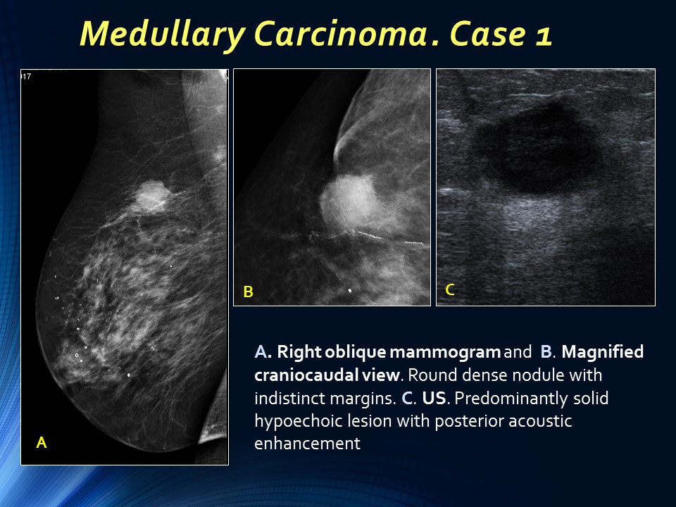 medullary carcinoma