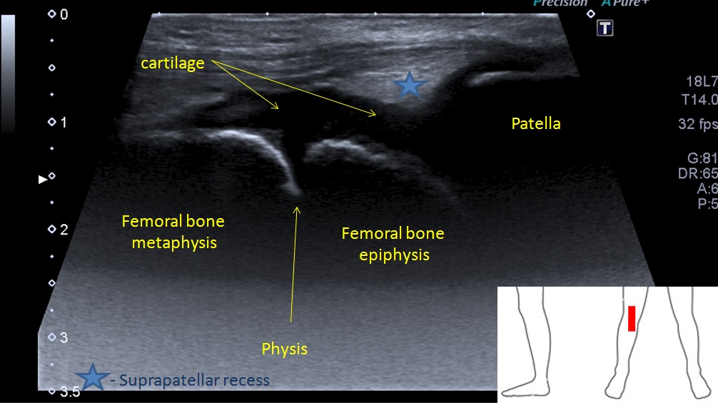 Knee Joint Ultrasound