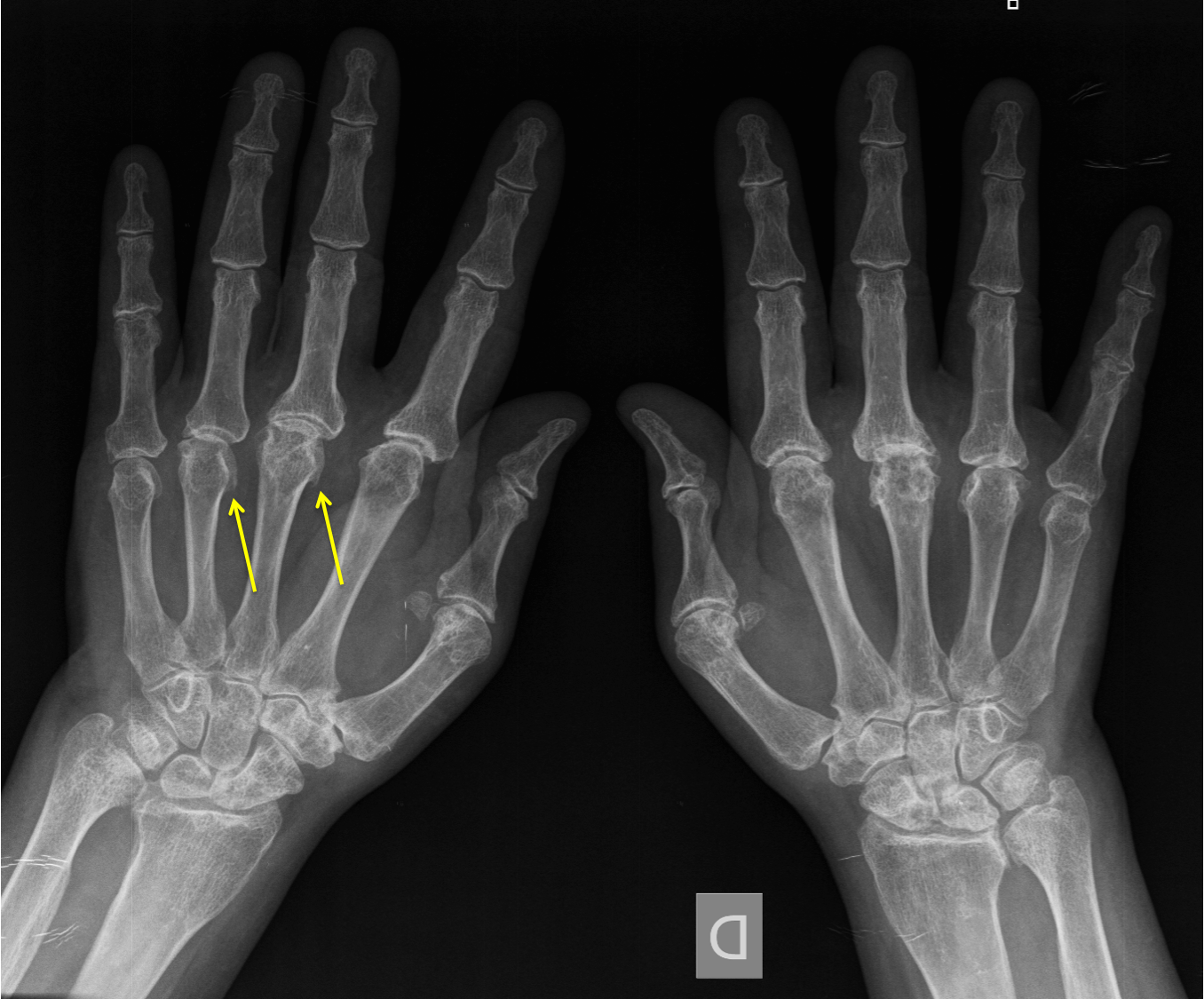 Osteoarthritis radiology hand