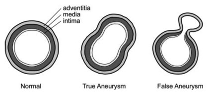 true aneurysm