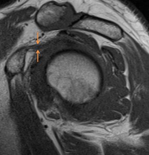 coracohumeral ligament mri