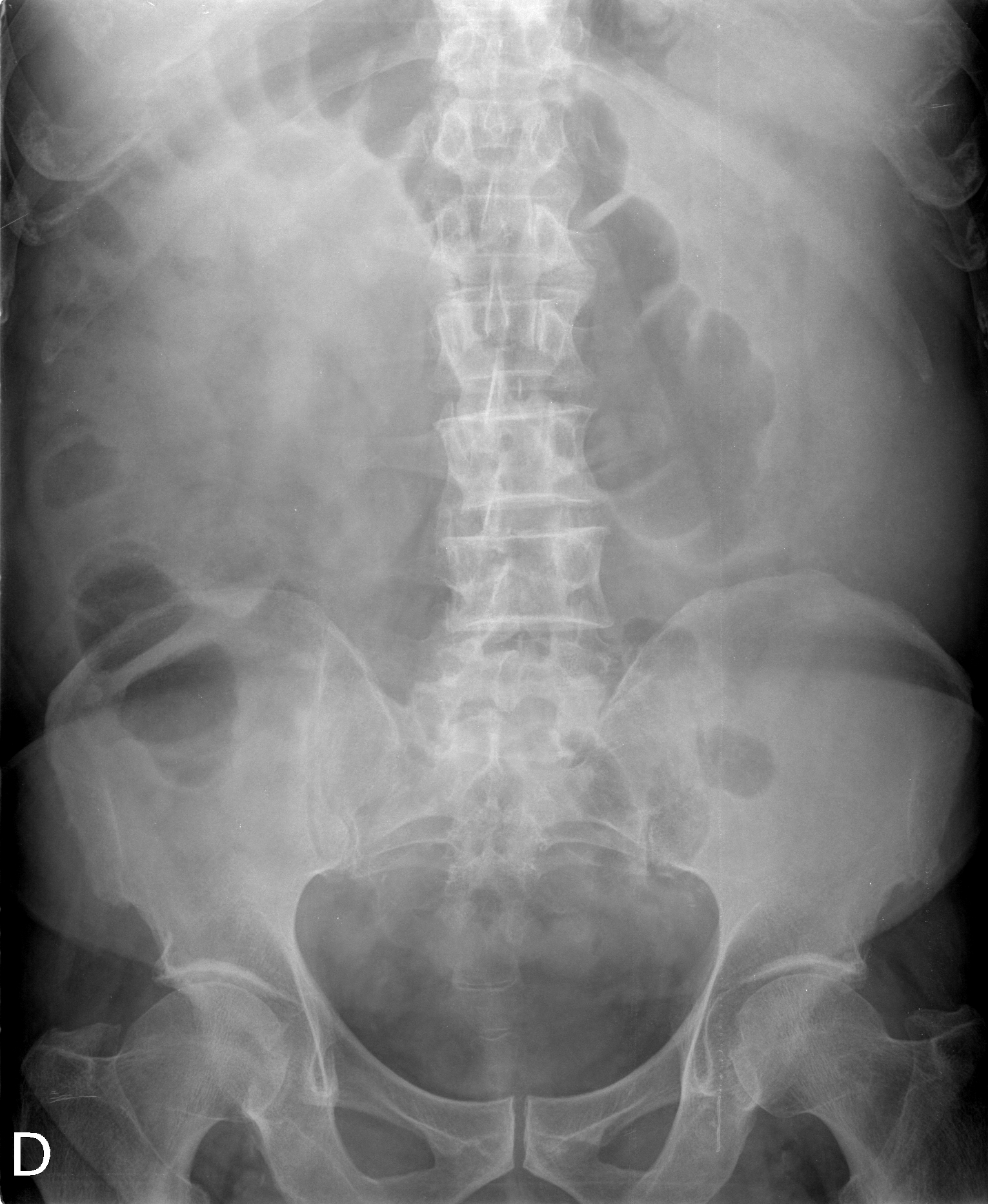 x ray colon cancer