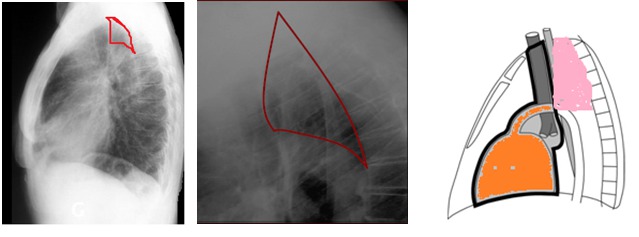 Lateral triangular space  Radiology Reference Article
