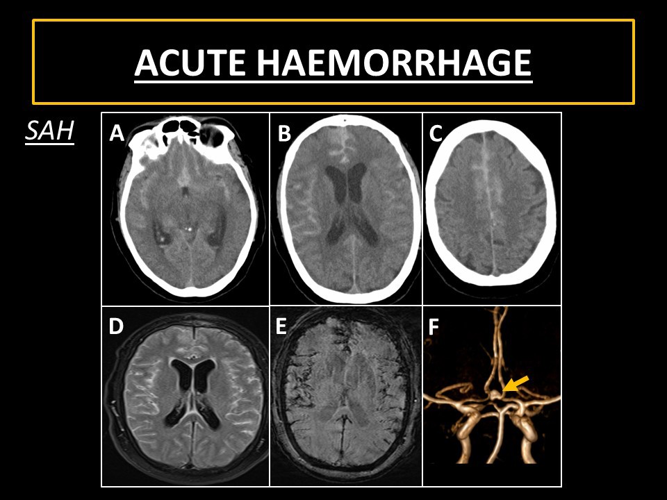 The subarachnoid hemorrhage (SAH) stages. The yellow arrows