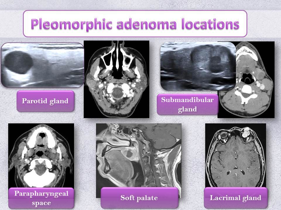 pleomorphic adenoma parotid radiology fertőzések prosztata férfiakban
