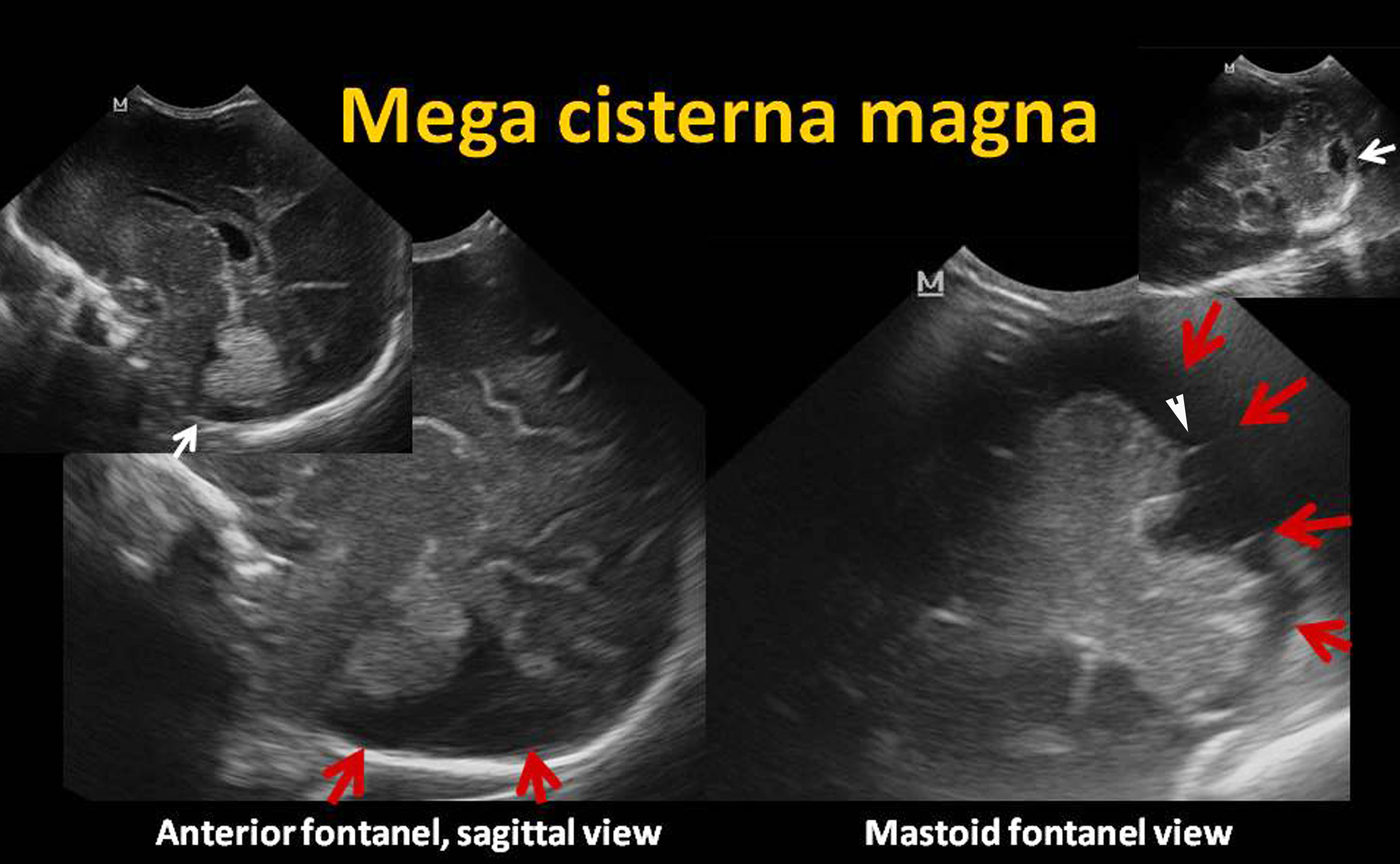 cisterna magna anatomy