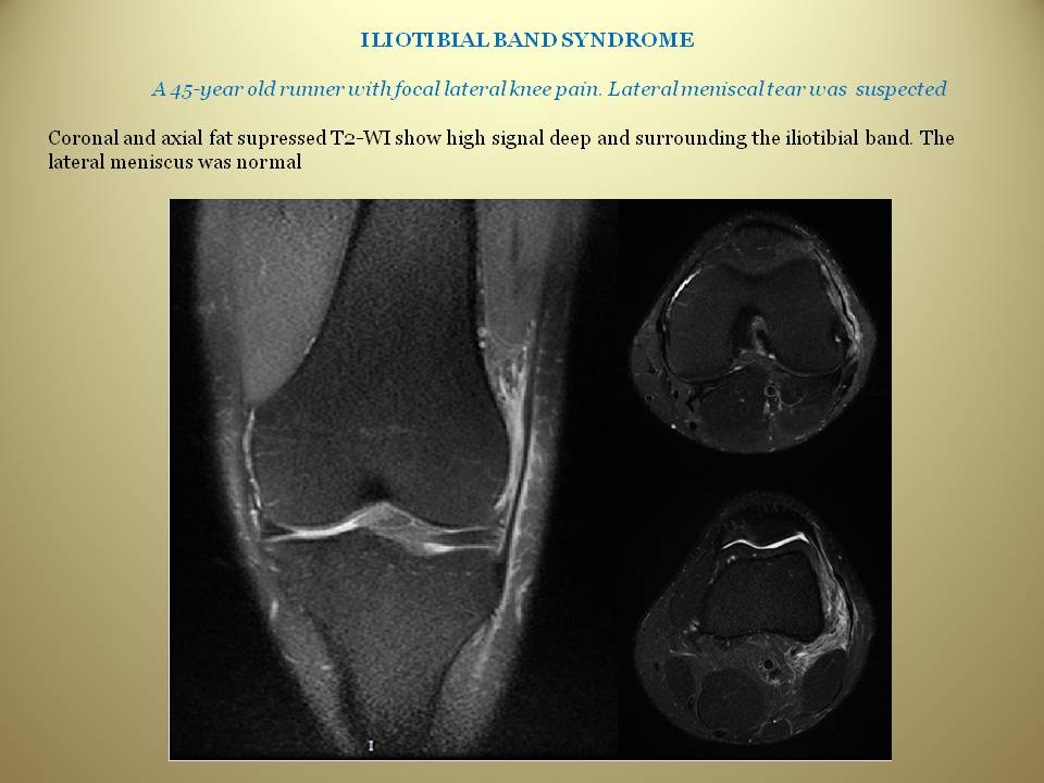 Iliotibial band syndrome x ray, Physiotherapy in Budapest