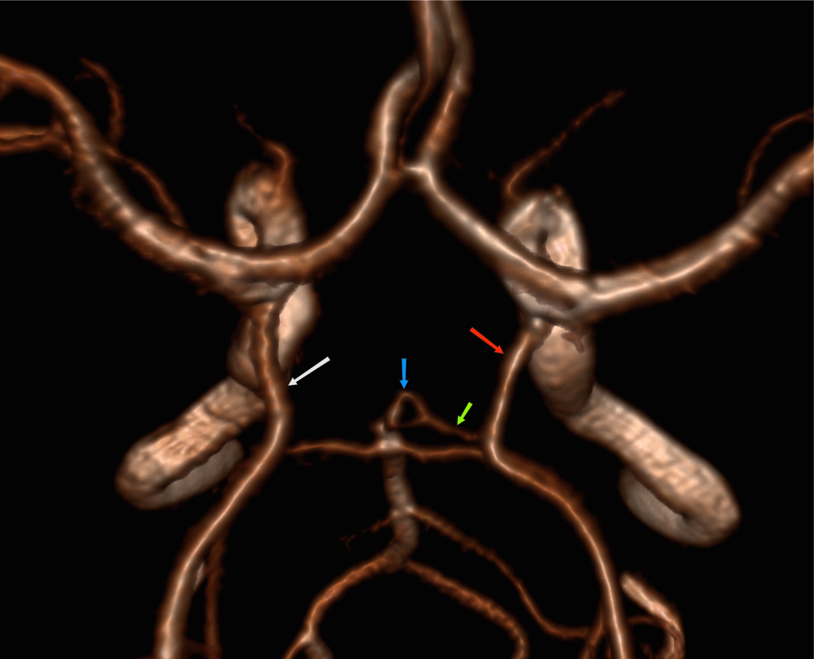 Развитие виллизиева круга в виде отсутствия кровотока. Гипоплазия правой позвоночной артерии сегменты. Гипоплазия р1 сегмента мозговой артерии. Гипоплазия правой передней передней мозговой артерии. Гипоплазия сегмента а1 правой ПМА.