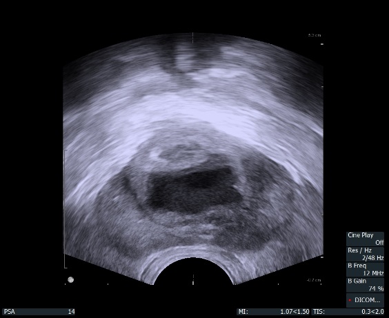 prostate abscess ultrasound